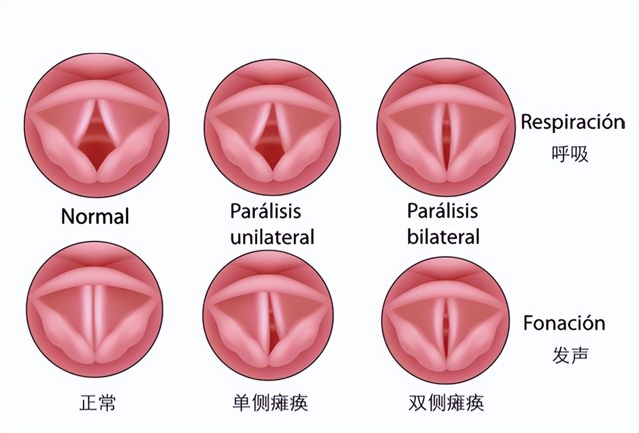 痉挛性发声障碍是怎么引起的原因