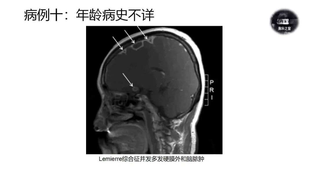 lemierre综合症